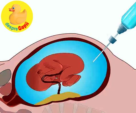 Amniocenteza precoce