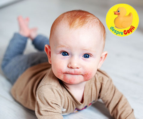 Eczema la bebelusi: cum arata, cauze si tratament - ghid
