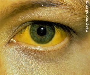 Hepatita A: simptome si ce e facut