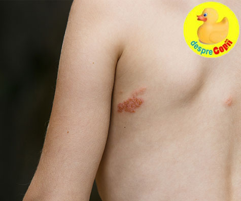 Remedii pentru impetigo