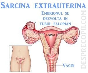 sarcina-extrauterina-cauze.jpg
