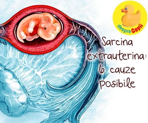 Sarcina extrauterina: 6 cauze posibile
