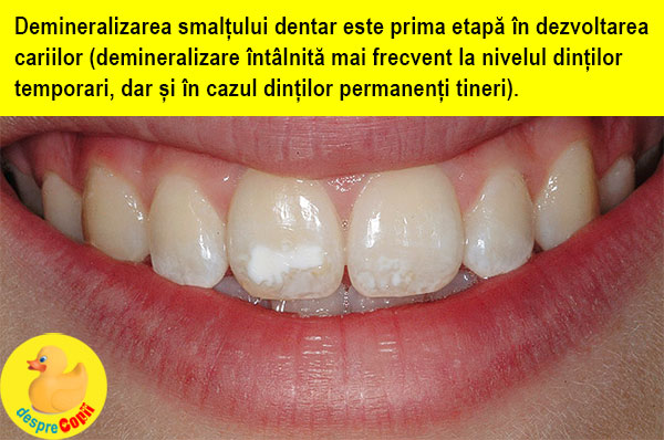demineralizarea dinti