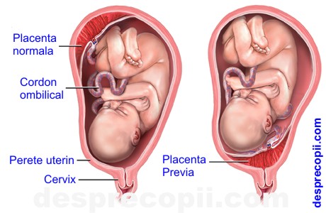/Images/placentaprevia.jpg