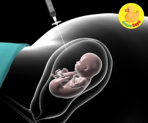 Amniocenteza precoce: motive si dificultati - sfatul medicului
