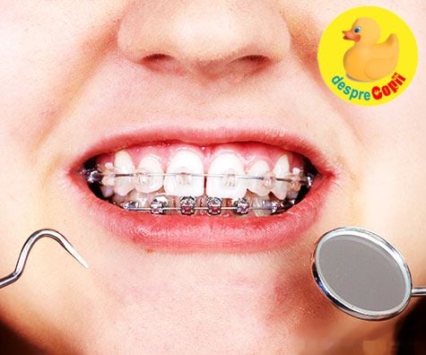 De ce trebuie purtat aparatul dentar in copilarie: motive si beneficii