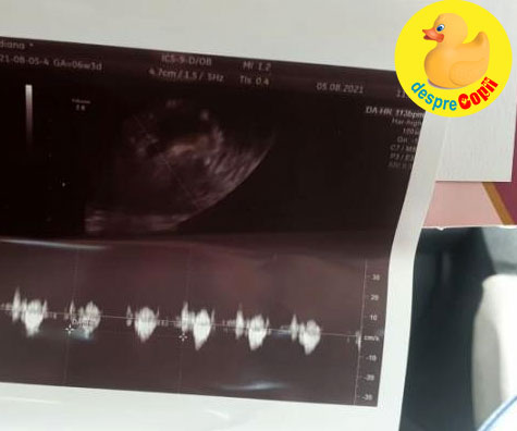 O sarcina prin FIV: primele batai de inimioara le-am auzit in saptamana 7 - jurnal de sarcina