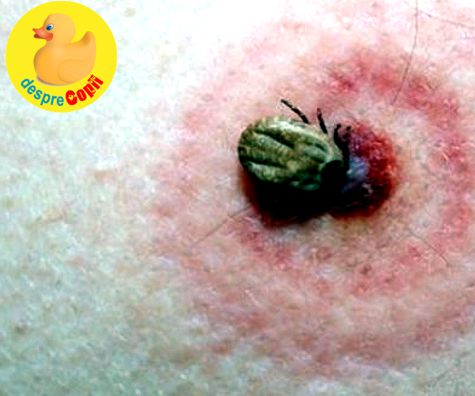 Boala Lyme (Borelioza)