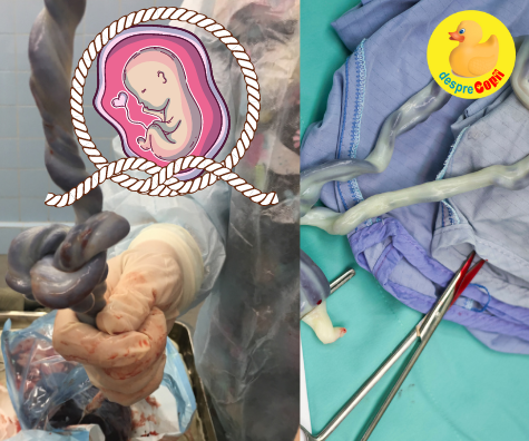 Cordonul nucal (cordonul ombilical in jurul gatului bebelusului) si nodul acestuia - situatii, riscuri si optiuni pentru siguranta bebelusului