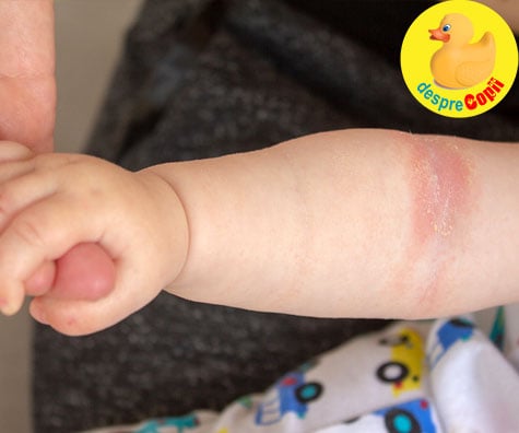 Cremele si produsele pentru bebelusi pot favoriza eczema - iata sfatul medicului dermatolog