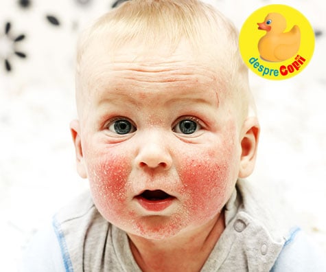 Ce este dermatita atopica la bebelusi si cum tratam aceasta afectiune severa a pielii ?