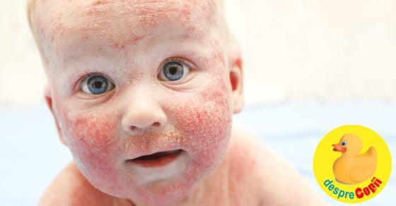 Dermatita atopică la copil: cauze și cum se tratează - sfatul medicului