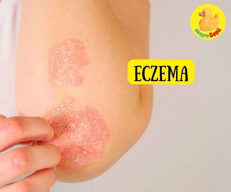 Cremele si produsele pentru bebelusi pot favoriza eczema - iata sfatul medicului dermatolog