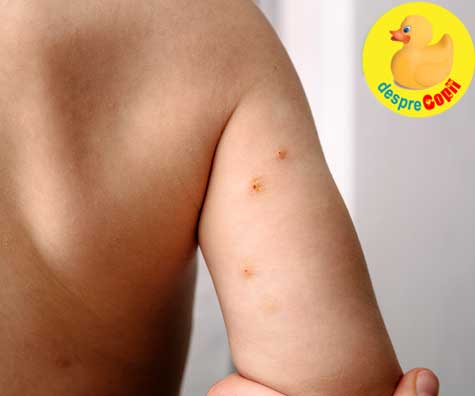 Molluscum Contagiosum sau verucile de apa la copii: Simptome si tratament