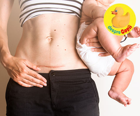Nu mai judecati mamicile care nasc prin cezariana si mai bine ascultati-le!