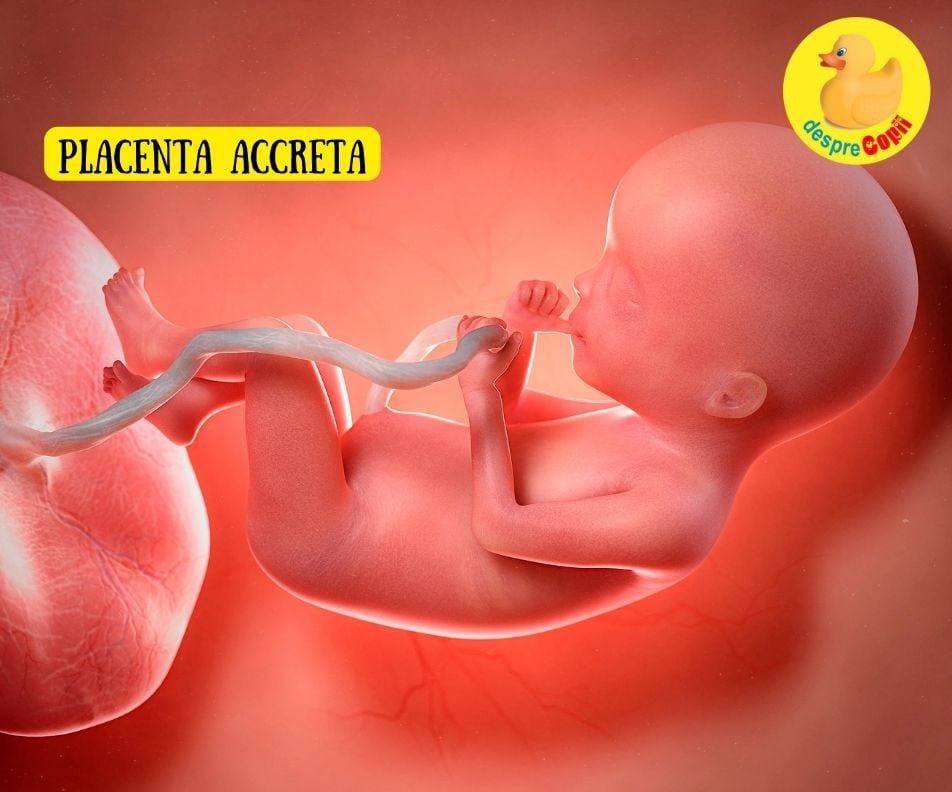 Placenta accreta: cauze, prevenire si tratament - sfatul medicului ginecolog