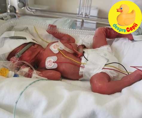 Fetita minune care s-a nascut la 25 de saptamani dupa ce mama nu a recunoscut durerile travaliului - o nastere foarte prematura