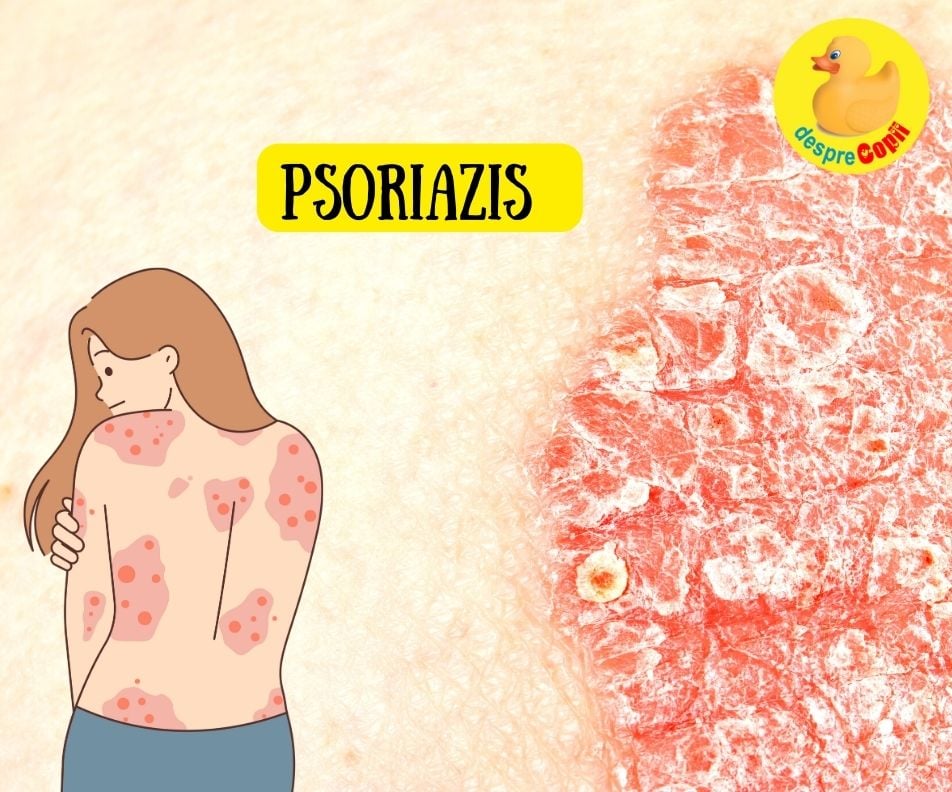 Psoriazisul la copii: simptome, tratamente si sfaturi pentru ingrijirea pielii sensibile - sfatul medicului dermatolog