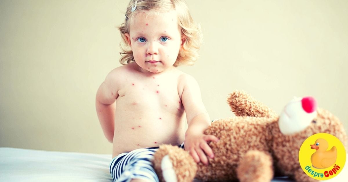 Pojarul (rujeola) la copil: simptome, cauze,tratament si prevenire - sfatul medicului