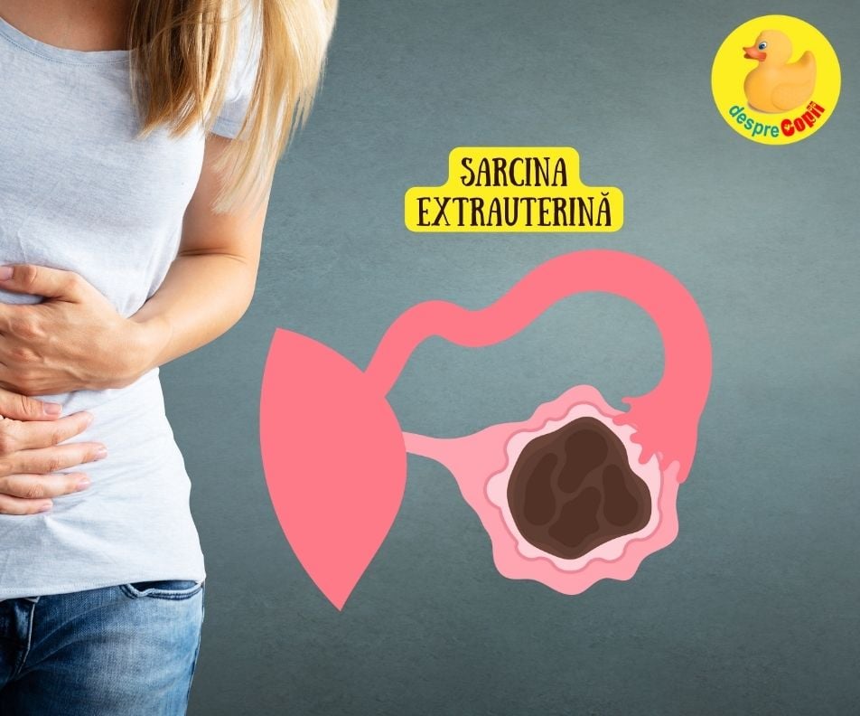 Se poate salva o sarcina extrauterina (ectopica)? Iata ce spun medici.
