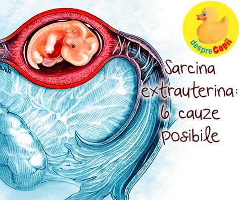 Sarcina extrauterina: 6 cauze posibile explicate de medicul ginecolog