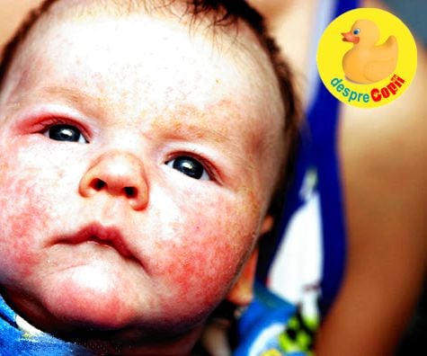 Alimentatia in sarcina, cheia protejarii bebelusului de eczeme