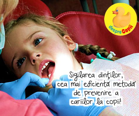 Sigilarea dintilor este cea mai eficienta metoda de prevenire a cariilor la copii