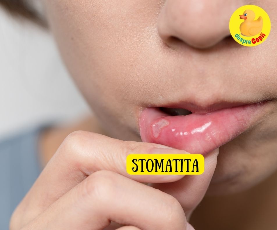 Stomatita la copil: simptome, tratament si atentionari - sfatul medicului