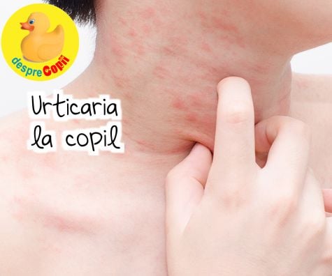 Urticaria la copil -  cauze, tipuri si tratament