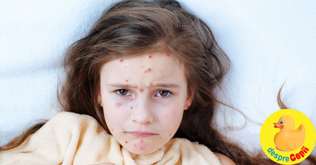 Varicela (vărsatul de vant) la copil: simptome, complicații, tratament - sfatul medicului