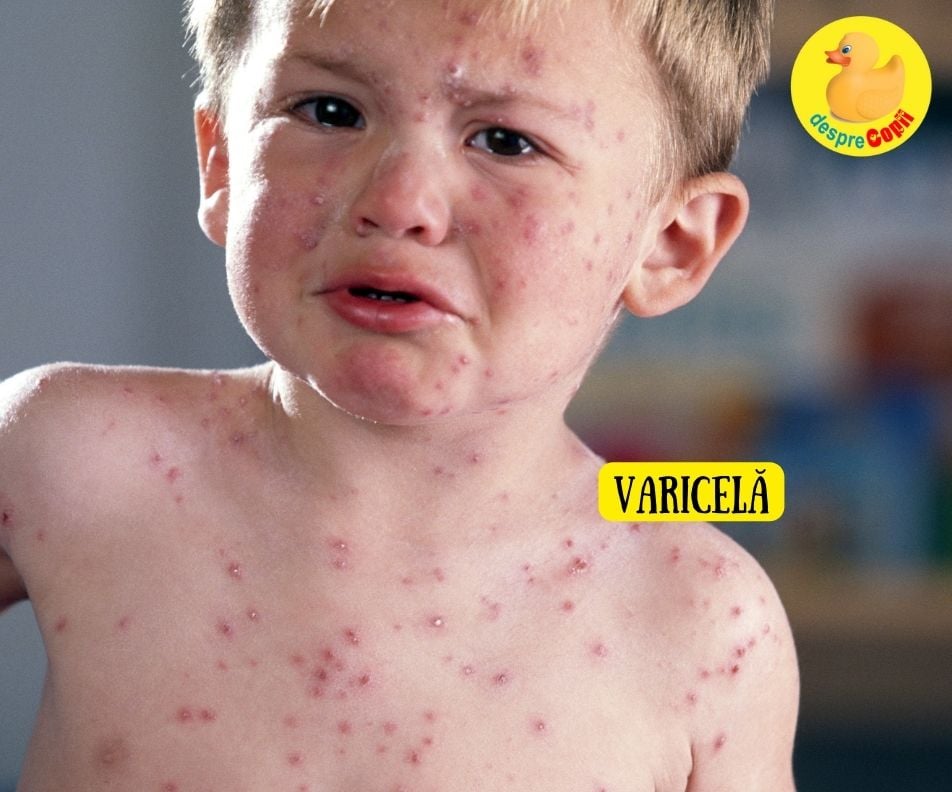 5 lucruri pe care ar trebui sa le stii despre varicela si zona zoster