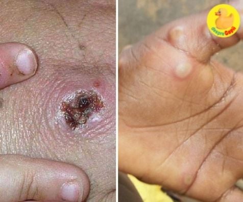 Variola maimutei sau monkeypox - ce simptome are si ce se stie despre acest virus