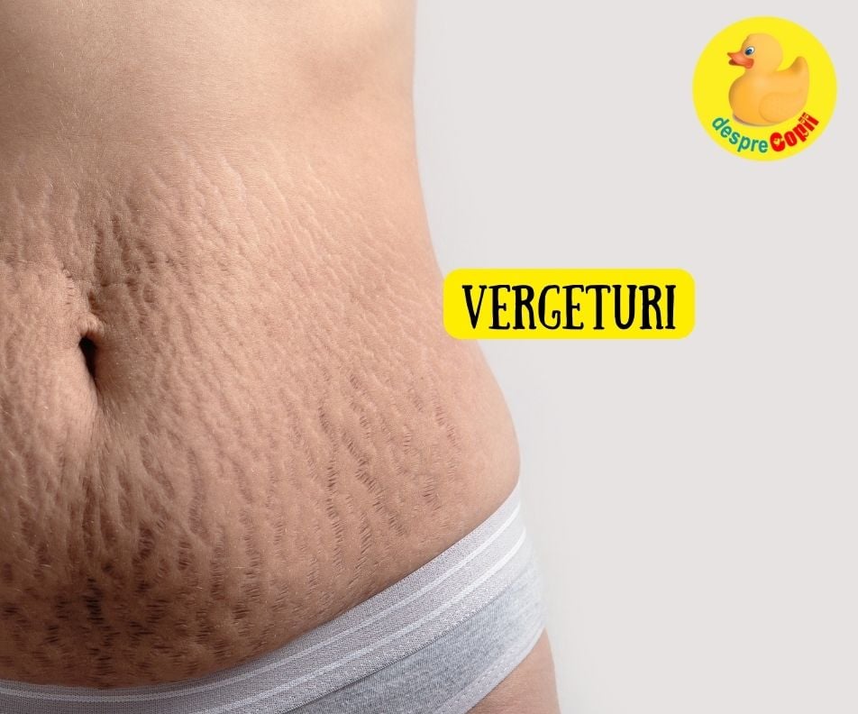 Vergeturile sau tatuajele naturii care ne amintesc de calatoriile vietii  - tratamente si 3 lucruri pe care trebuie sa le stii de la inceput