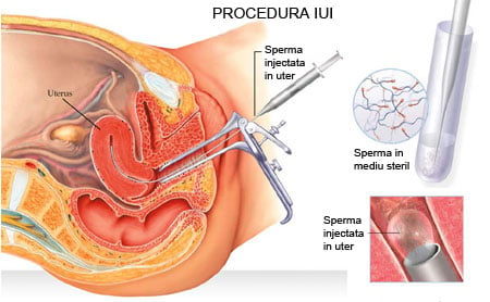 /Images/PROCEDURA-IUI.jpg