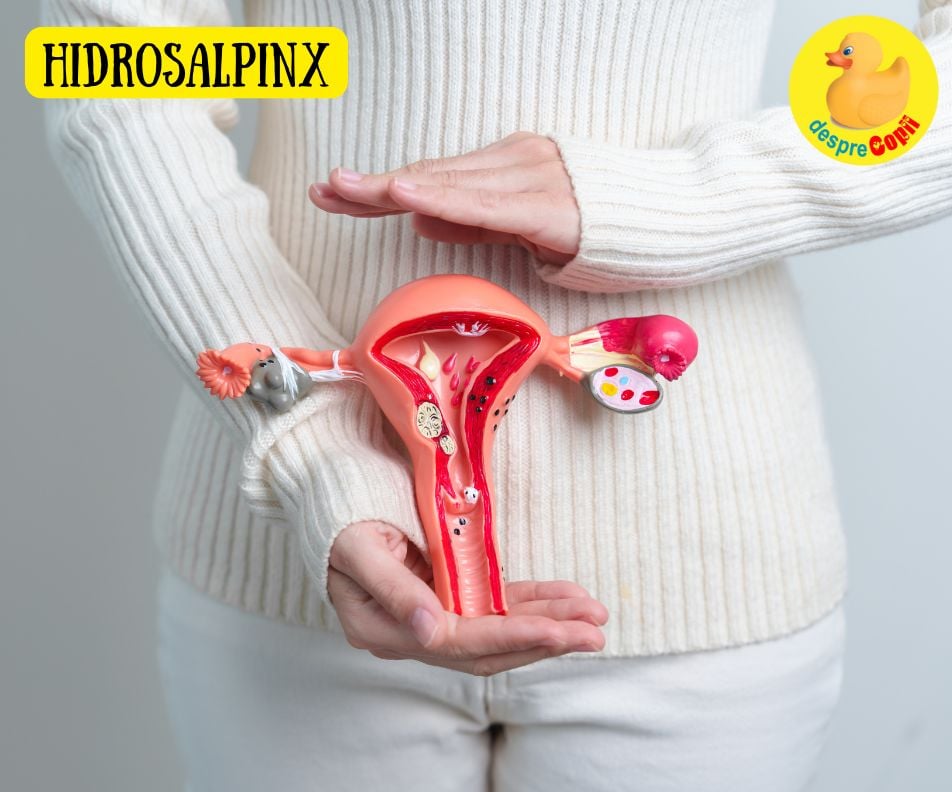 Hidrosalpinx si impactul sau asupra fertilitatii