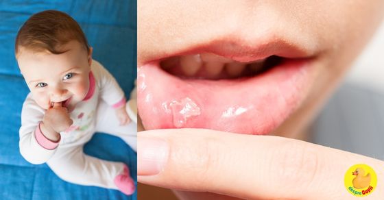 Aftele bucale la nou-nascuti: cauze si tratament