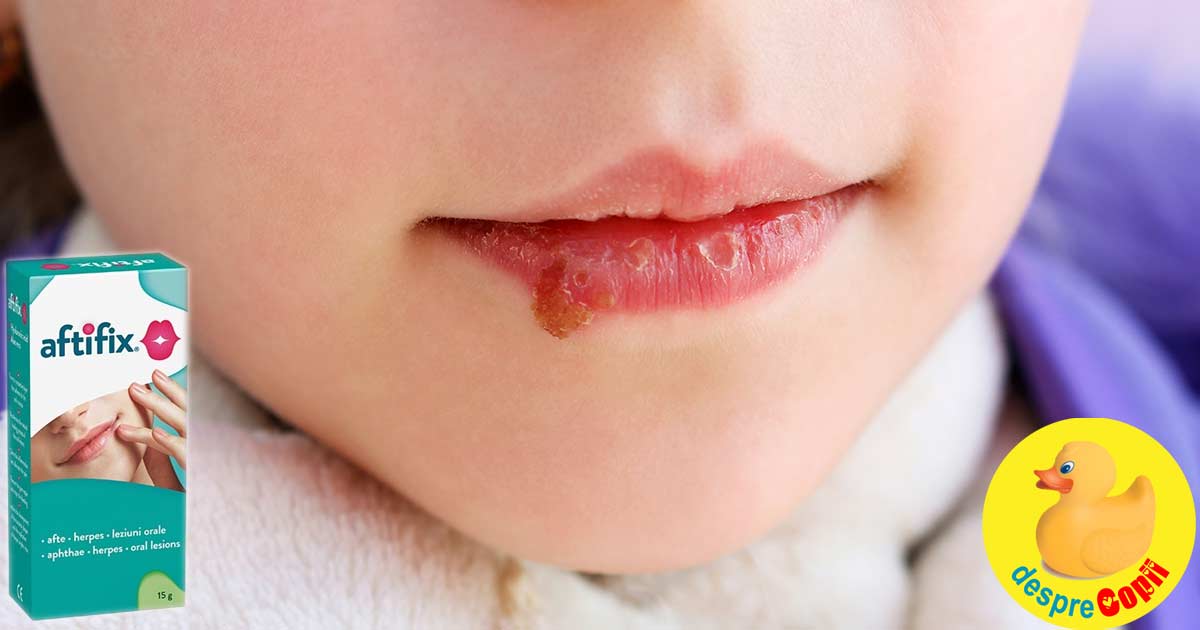 Cele mai frecvente afectiuni orale la copil: aftele si herpesul. Cum putem ajuta copilul?