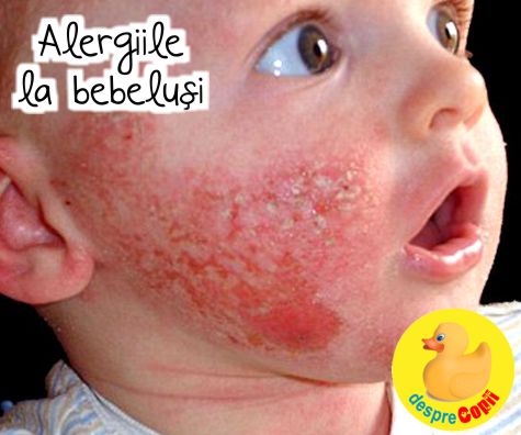 Alergiile la bebelusi: tot ce trebuie sa stii