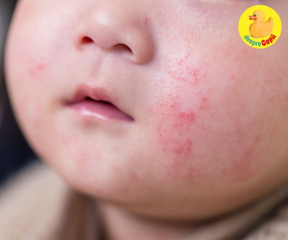 Alergiile alimentare la bebelusi - sfatul medicului pediatru