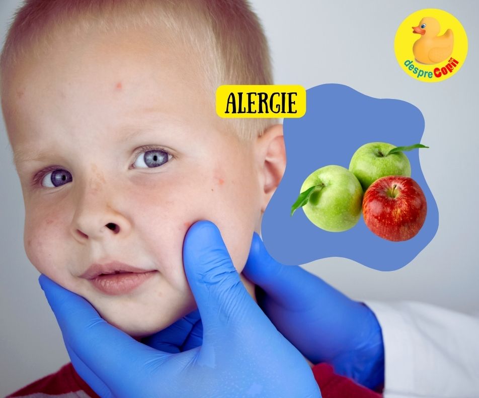 Alergia la mere la copii - alergia care te poate surprinde -  iata ce simptome are si cum trebuie procedat