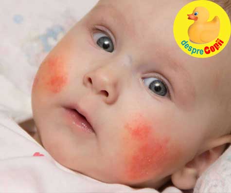 Alergiile alimentare la bebelusi - sfatul medicului pediatru