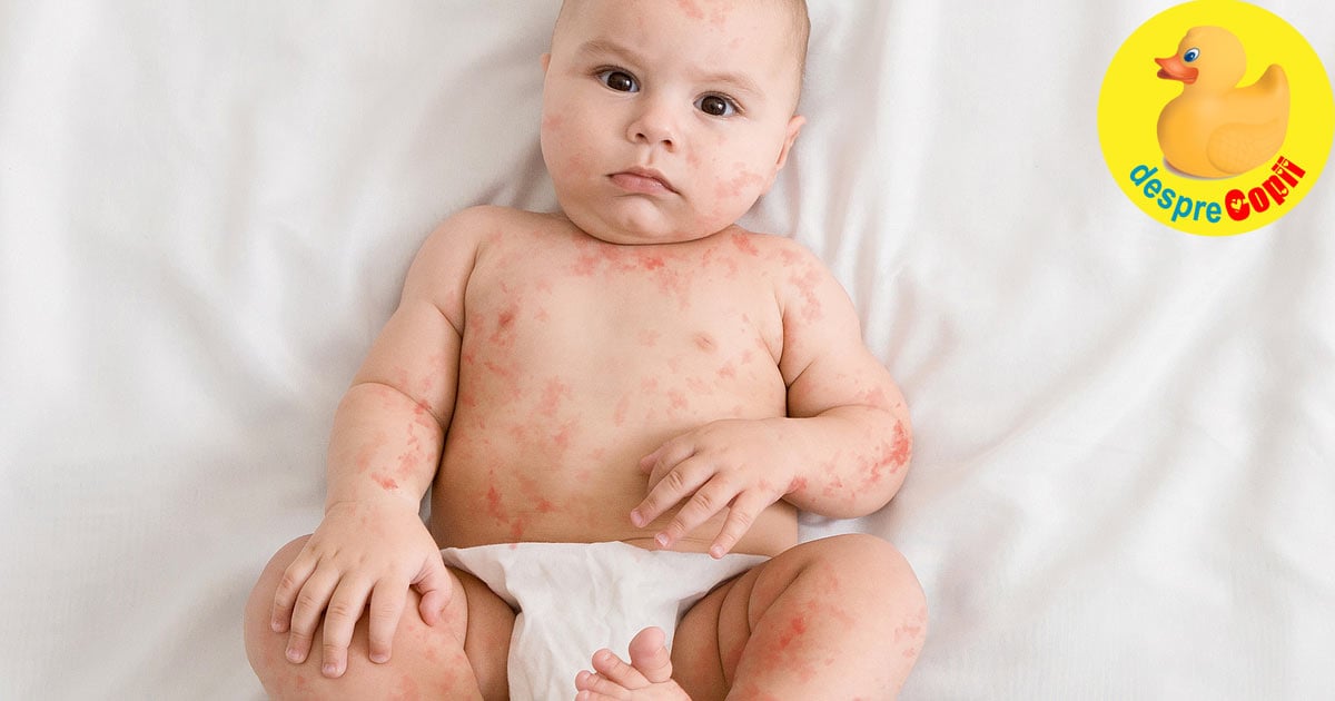 Ce alimente pot produce alergie bebelusului?