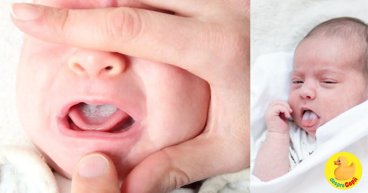 Cand bebe are o limba alba laptoasa - ce e bine de stiut