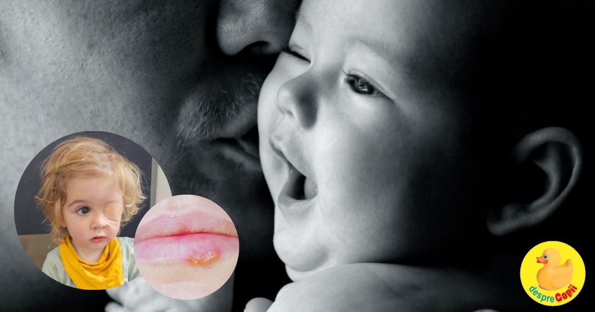 Copil de 2 ani care isi pierde un ochi dupa ce a fost pupat de cineva infectat cu herpes - ce trebuie sa stie toti parintii
