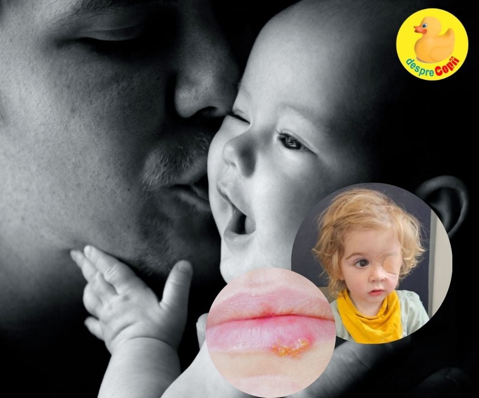 Copil de 2 ani care isi pierde un ochi dupa ce a fost pupat de cineva infectat cu herpes - ce trebuie sa stie toti parintii