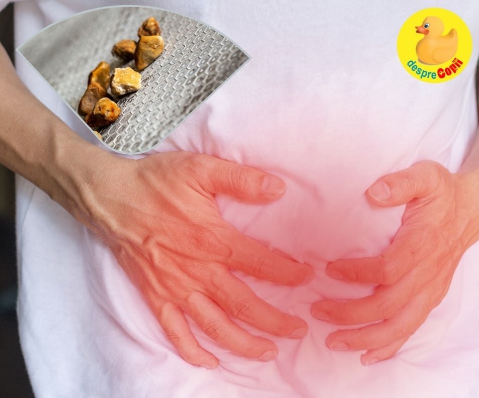 Calculii biliari: remediu natural de eliminare fara operatie chirurgicala