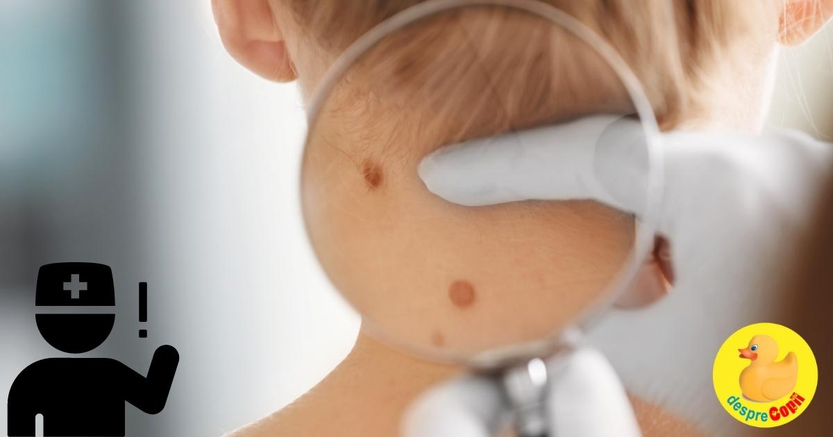 Carcinomul bazocelular - cea mai comuna forma de cancer de piele: riscuri si simptomul precoce