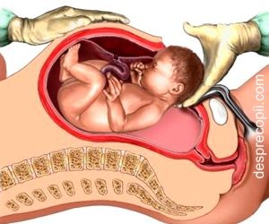 Operatia cezariana si riscurile legate de placenta