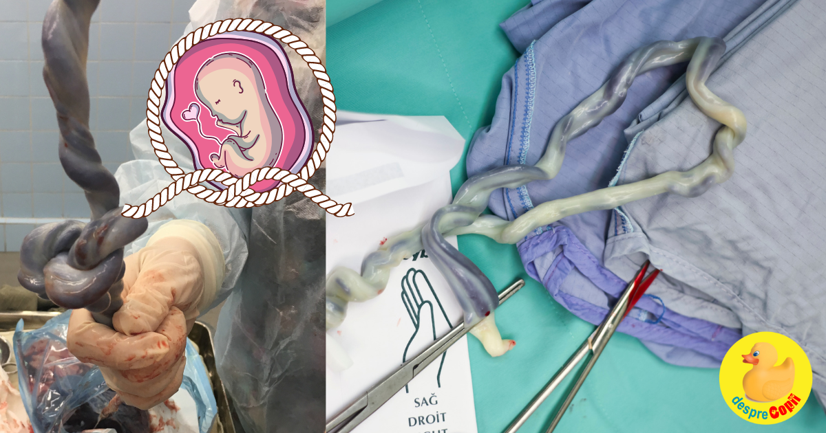 Cordonul nucal (cordonul ombilical in jurul gatului bebelusului) si nodul acestuia - situatii, riscuri si optiuni pentru siguranta bebelusului