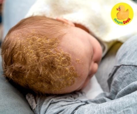 Crusta de lapte sau dermatita seboreica infantila - cauze si cum se trateaza la bebelusi